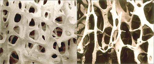 Confronto tra tessuto osseo trabecolare in un individuo sano e in un individuo affetto da osteoporosi, rispettivamente [ Morosetti, F. Osteoporosi: L'osso fragile Sconfini.eu.]