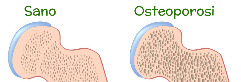 osteoporosi katia marozzi nutrizionista